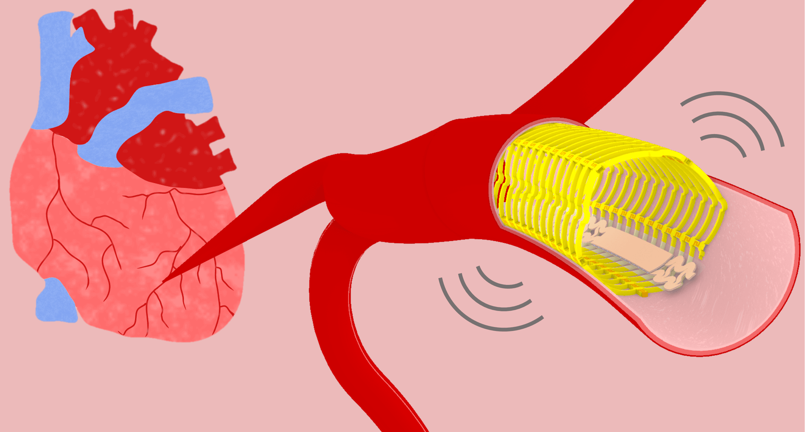 Vascular Health: The Power of Implantable Wireless Electronics