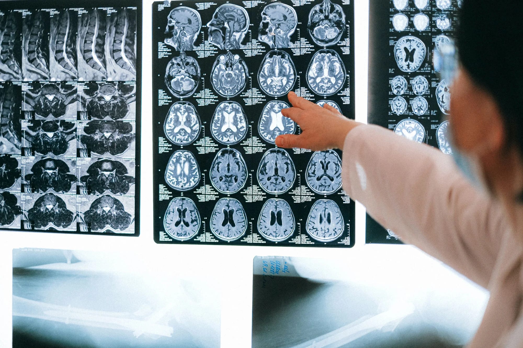 An artificial intelligence platform accurately diagnoses dystonia